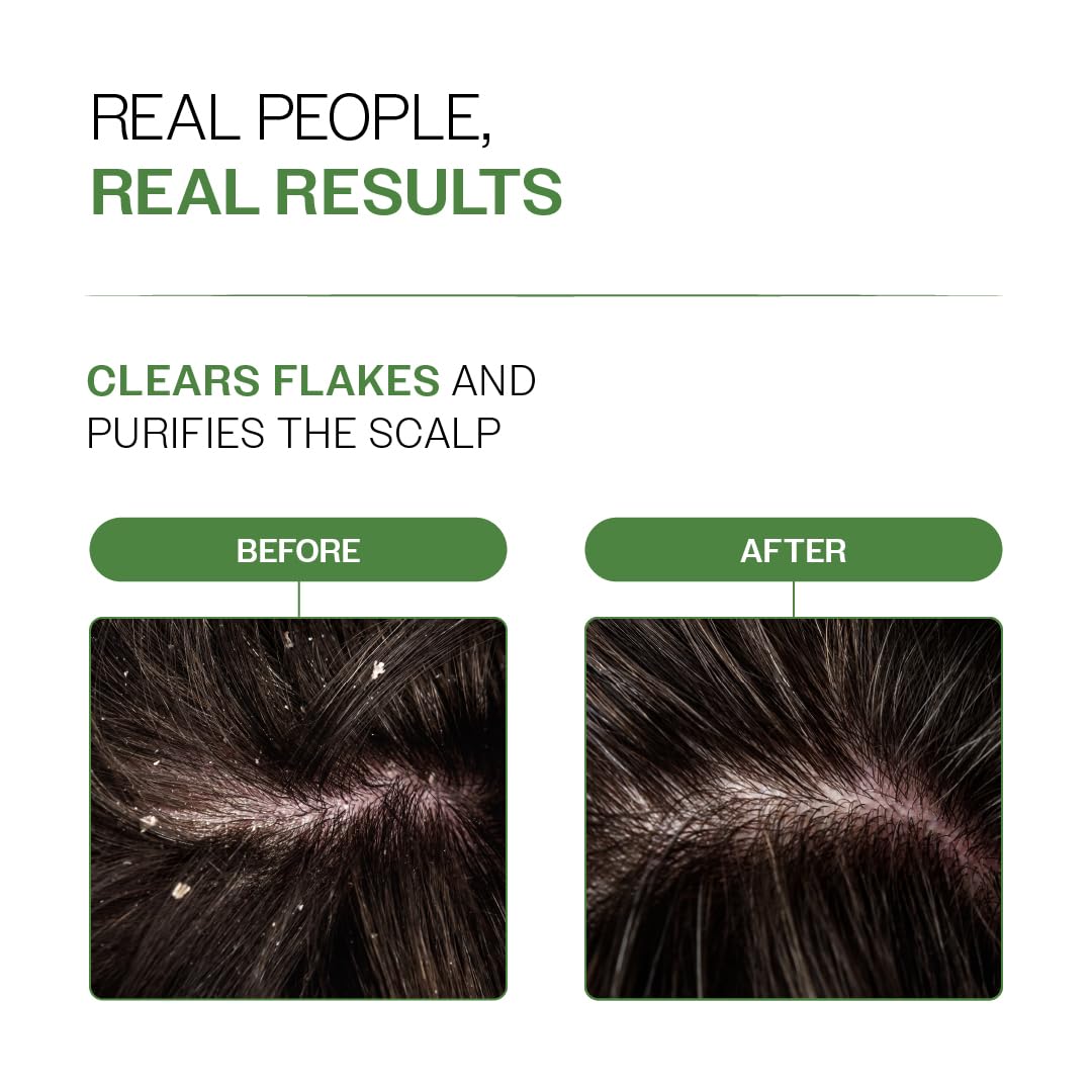 Bare Anatomy Nature x Science Dandruff Control Scalp Spray for Dandruff & Flake Reduction - 200 ml