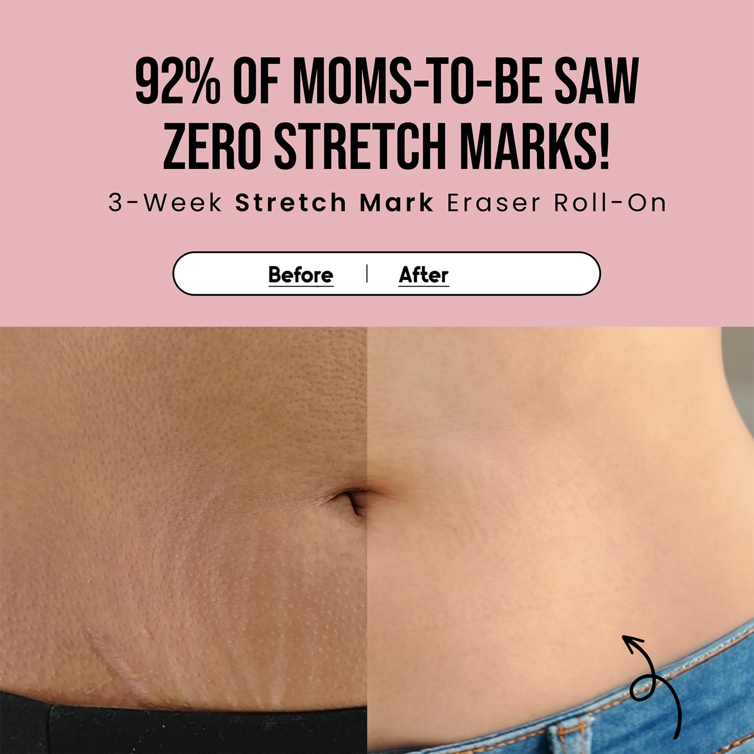 Cos-IQ Stretch Marks Removal Roll-On Serum with Striover