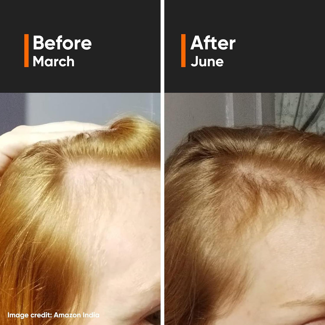 Minimalist Hair Growth Serum With 3% Redensyl, 3% Anagain, 3% Procapil, 5% Capixyl & 4% Baicapil 18% Hair Growth Actives|30 ml